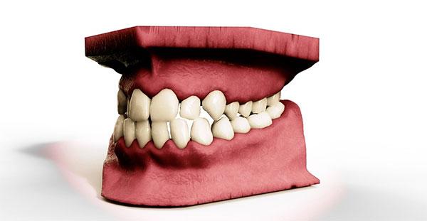 granuloma dentale come si cura