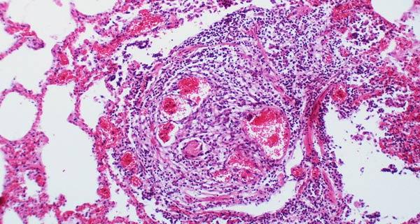 Angioma rubino quali cure